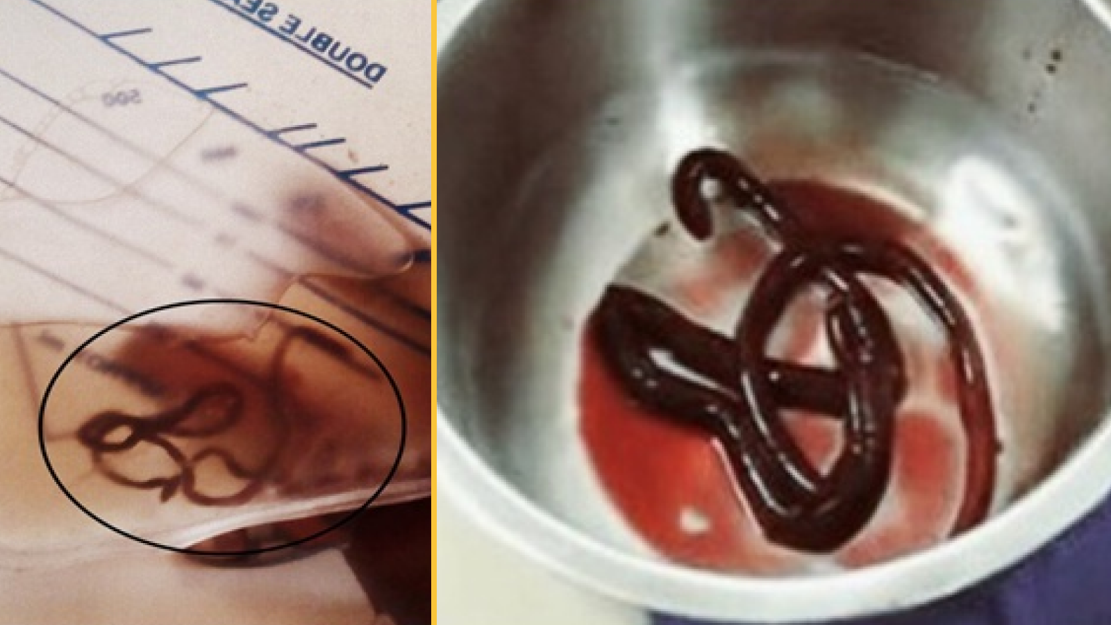 Мужчина не мог писать из-за гигантского паразита в почках