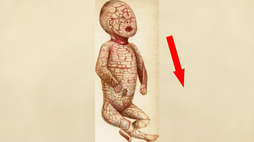  Harlequin ichthyosis: The rare genetic disease that gives babies hard 'scales' 