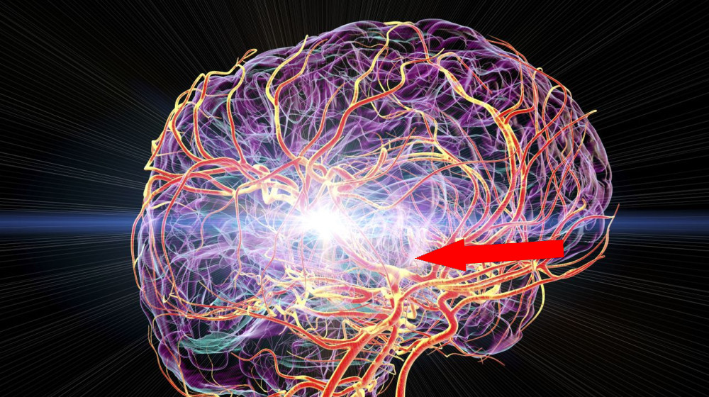  Mysterious migraines after heart surgery may finally be explained 