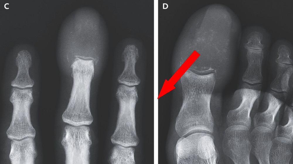  Weird swelling of man's fingers and toes revealed cancer had 'completely replaced' the bones with lesions 