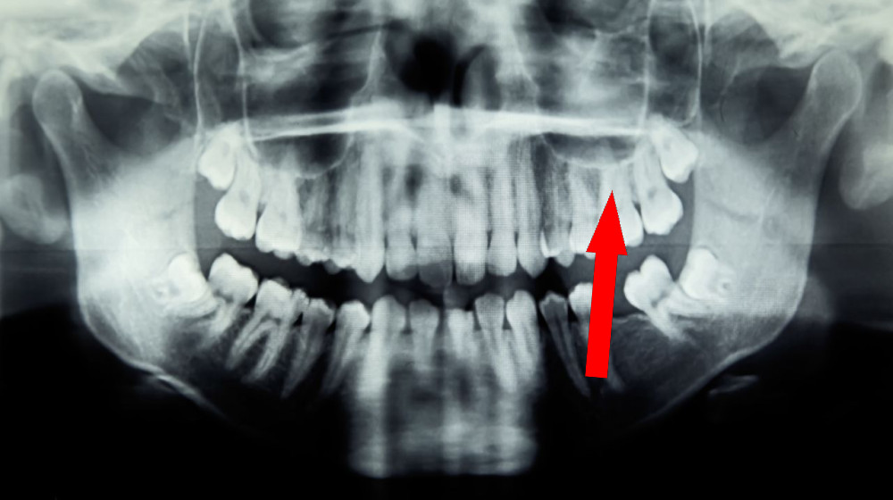  Diagnostic dilemma: Girl's dental trouble caused a life-threatening eye infection 