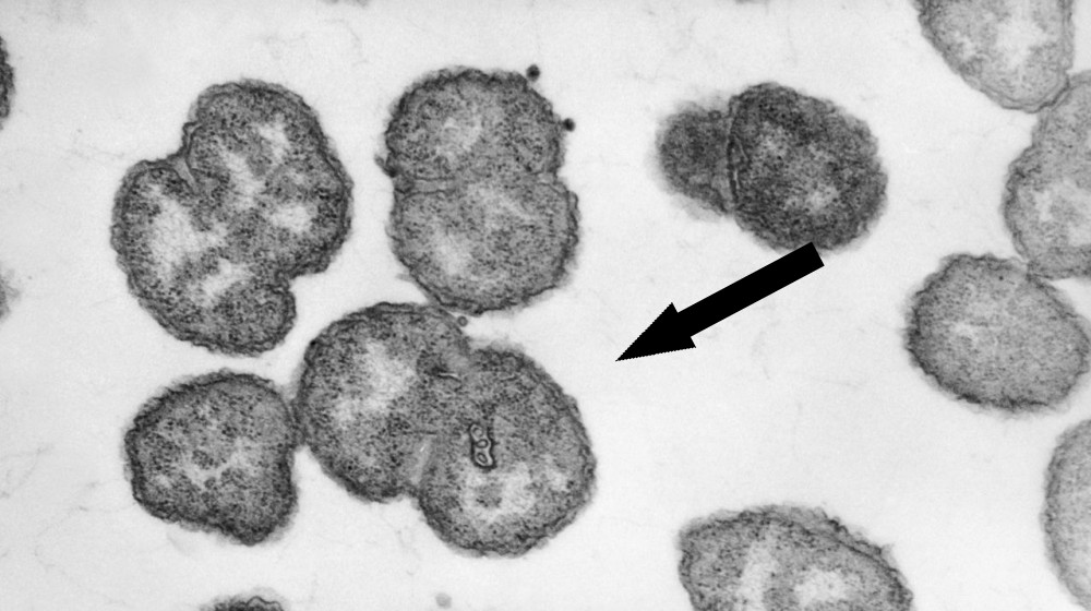  Diagnostic dilemma: A toddler accidently ate gonorrhea bacteria from a lab dish 