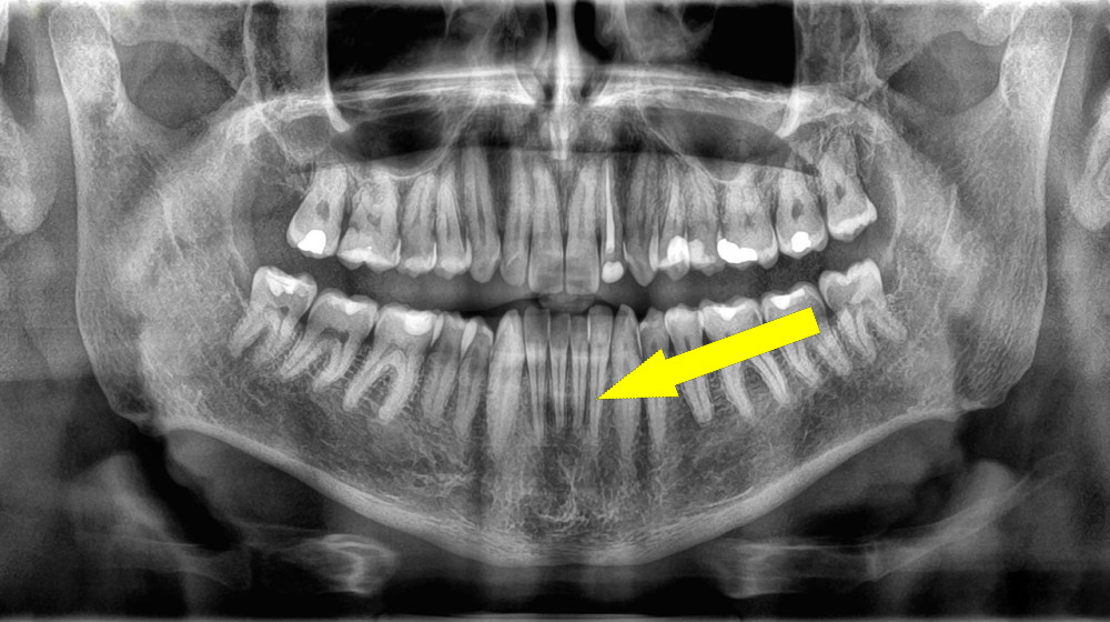  Why don't teeth count as bones? 