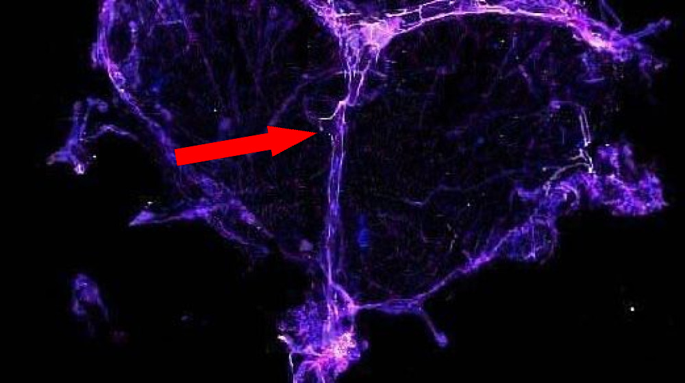  'Chemo brain' may stem from damage to the brain's drainage system 