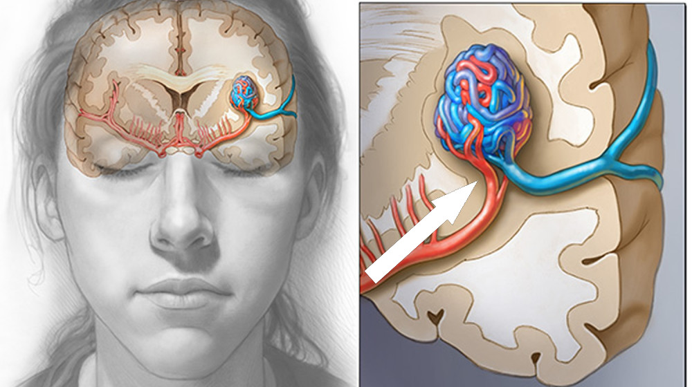  Diagnostic dilemma: Orgasm involving a kitchen whisk likely triggered person's fatal aneurysm 