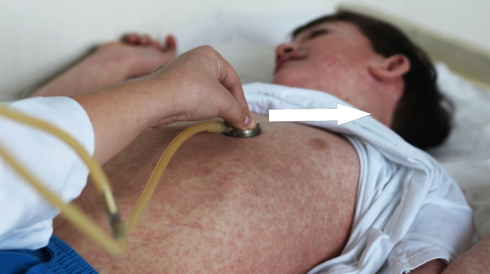  Canada has lost its 'measles elimination status' — here's what that means 