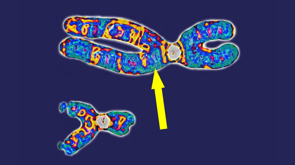  Diagnostic dilemma: Woman had her twin brother's XY chromosomes — but only in her blood 
