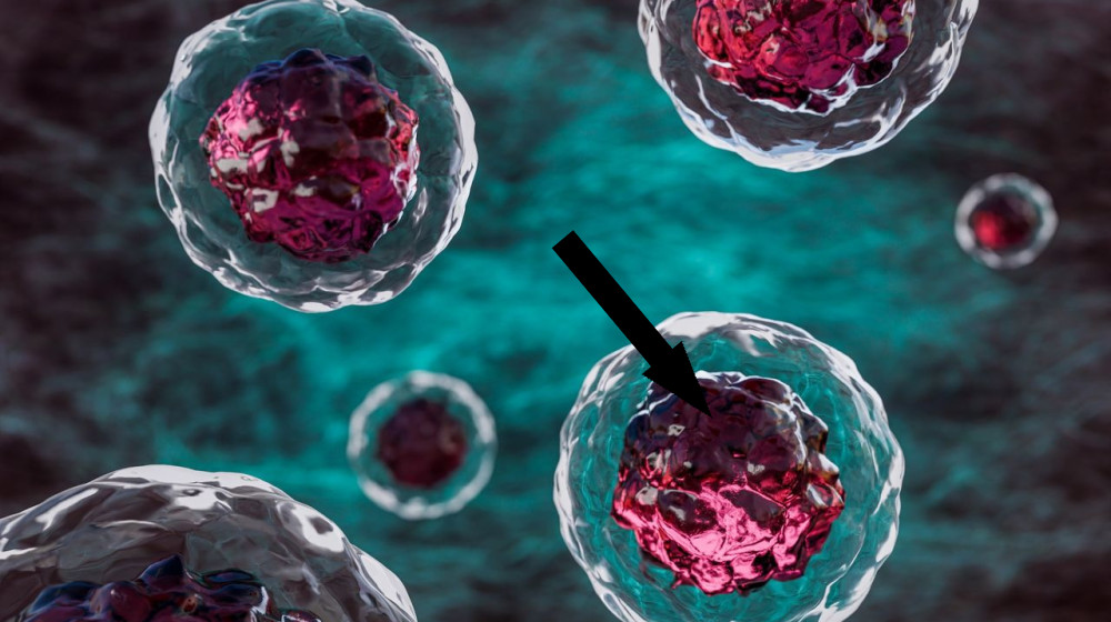  Slaying 'zombie cells' in blood vessels could be key to treating diabetes, early study finds 