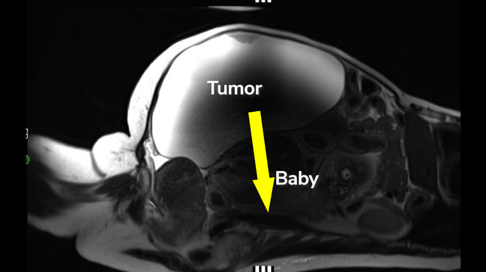  'Unprecedented': Woman delivers full-term abdominal pregnancy while also having 22-pound cyst removed 