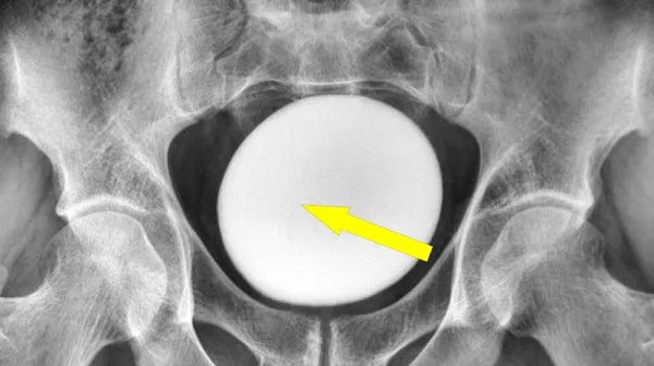  Diagnostic dilemma: Giant 'stone' in a man's bladder looked like an ostrich egg 