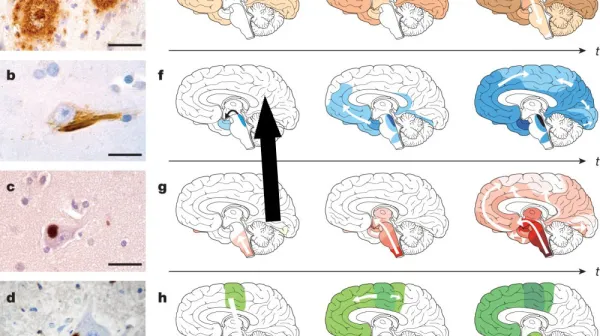 Почему воспаление и повреждение ДНК приводят к развитию хронической травматической энцефалопатии