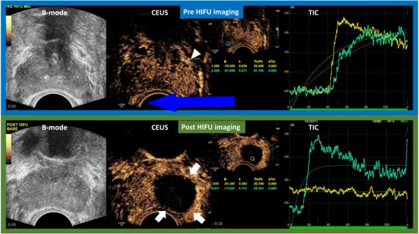 Цветовая слепота может снизить шансы на выживание при раке мочевого пузыря ученые предполагают
