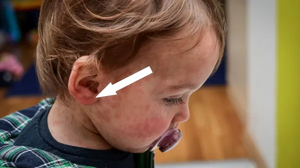  The UK has lost its measles elimination status — again 