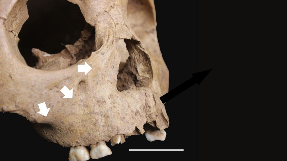 Древние зубы детей раскрывают страшную эпидемию сифилисообразной болезни в Вьетнаме 4000 лет назад