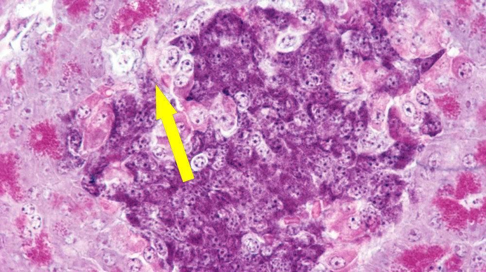 Новое открытие в борьбе с диабетом ТИПА 1: ученые создали смешанную иммунную систему у мышей