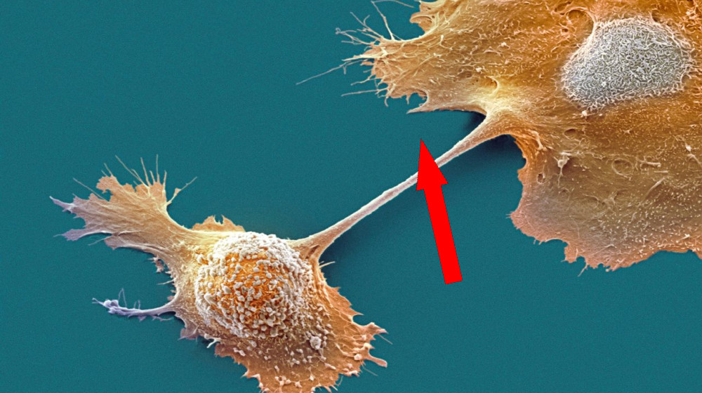 Новое лекарство резко увеличивает шансы на выживание при раке поджелудочной железы