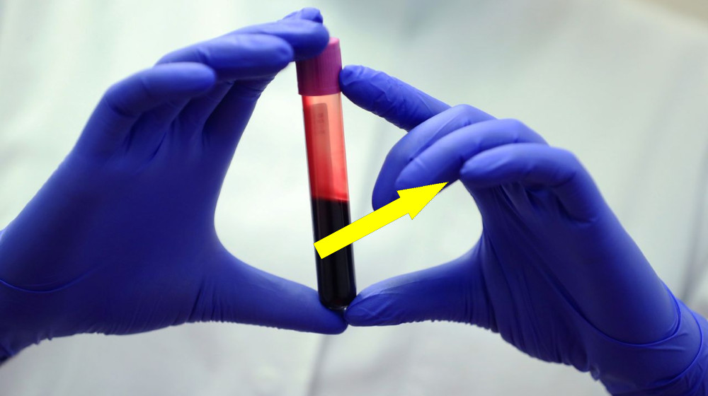 Новый кровяной тест раскрывает скрытую опасность печени до появления рака