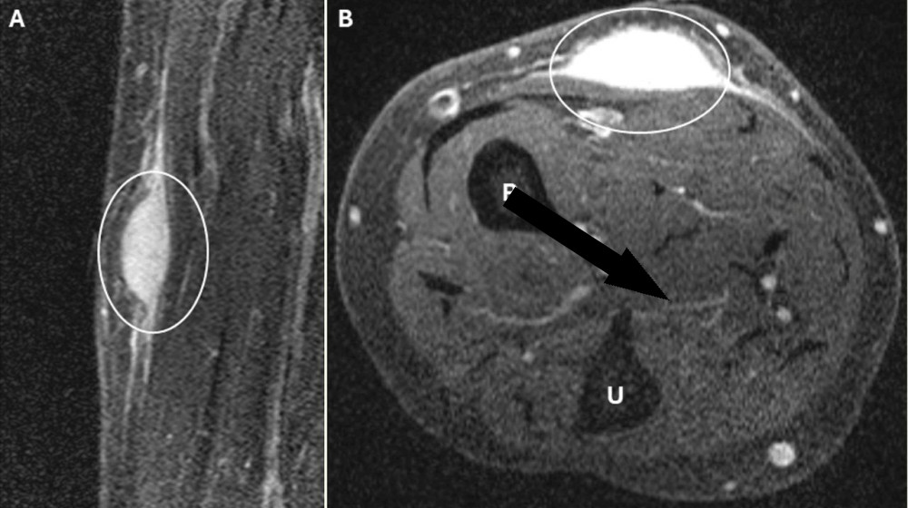  Diagnostic dilemma: Biopsy triggered 'spontaneous regression' of woman's arm tumor 