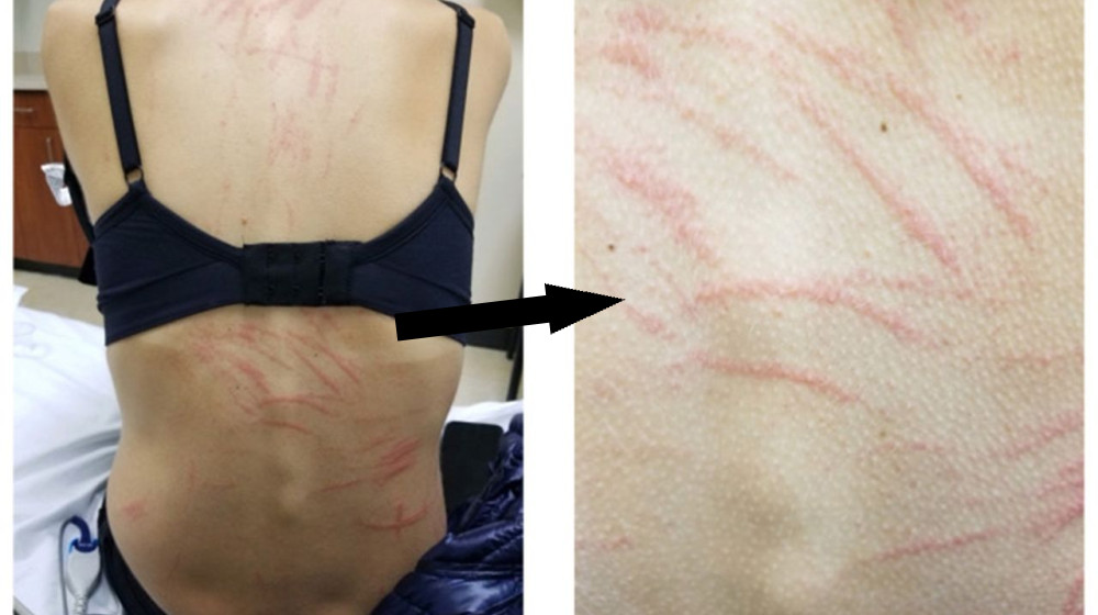  Diagnostic dilemma: Whiplike rashes appeared on a woman's back after she ate shiitake mushrooms 