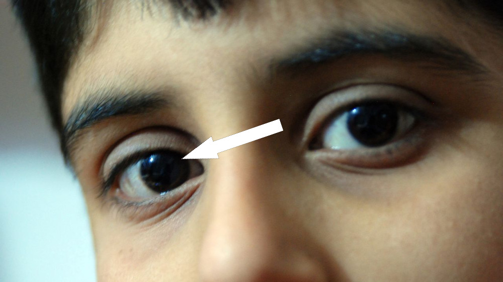  Diagnostic dilemma: Doctors couldn't explain why a boy was bleeding from his eyes, ears and nose 